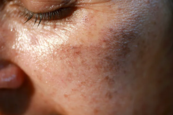 Fragment twarzy pokrytej piegami.